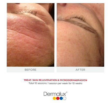 Dermapen 4 Micro Needling treatment